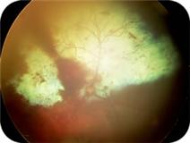 bloeding oog 2